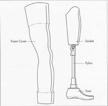 A typical artificial limb, in this case an above-the-knee prosthesis. The foam cover is covered with artificial skin that is pointed to match the patient's natural skin color.