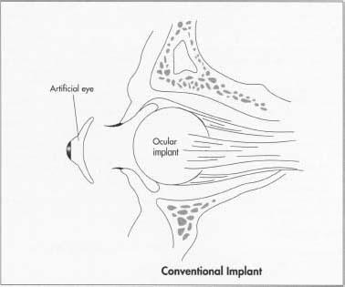 For a conventional implant, the surgeon removes the eyeball by severing the muscles, which are connected to the sclera (white of eyeball). The surgeon then cuts the optic nerve and removes the eye from the socket. An implant is then placed into the socket to restore lost volume and to give the artificial eye some movement, and the wound is closed.