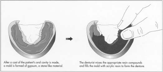 Denture