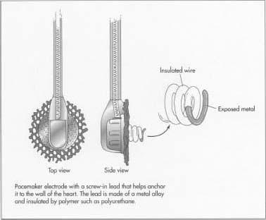 Pacemaker