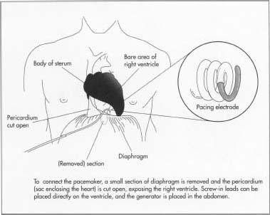 Pacemaker