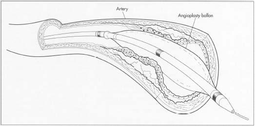 An angioplasty balloon is inserted into a clogged artery and inflated to clear 6lockage and allow blood to flow.