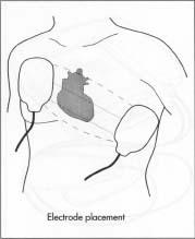 The positioning of the defibrillator's paddles.